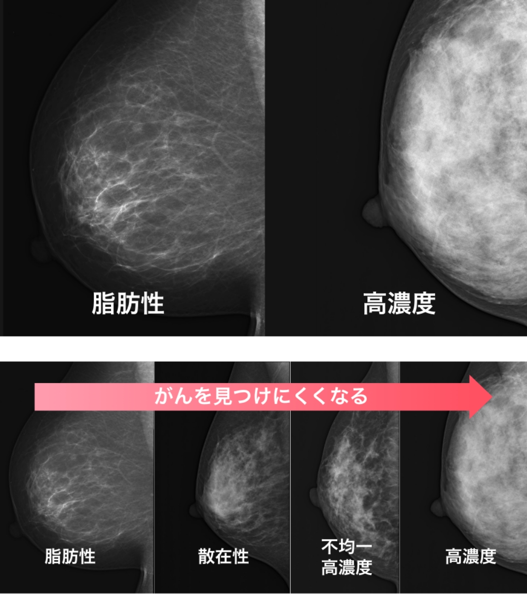 MRI検査でのがんの見え方のイメージ