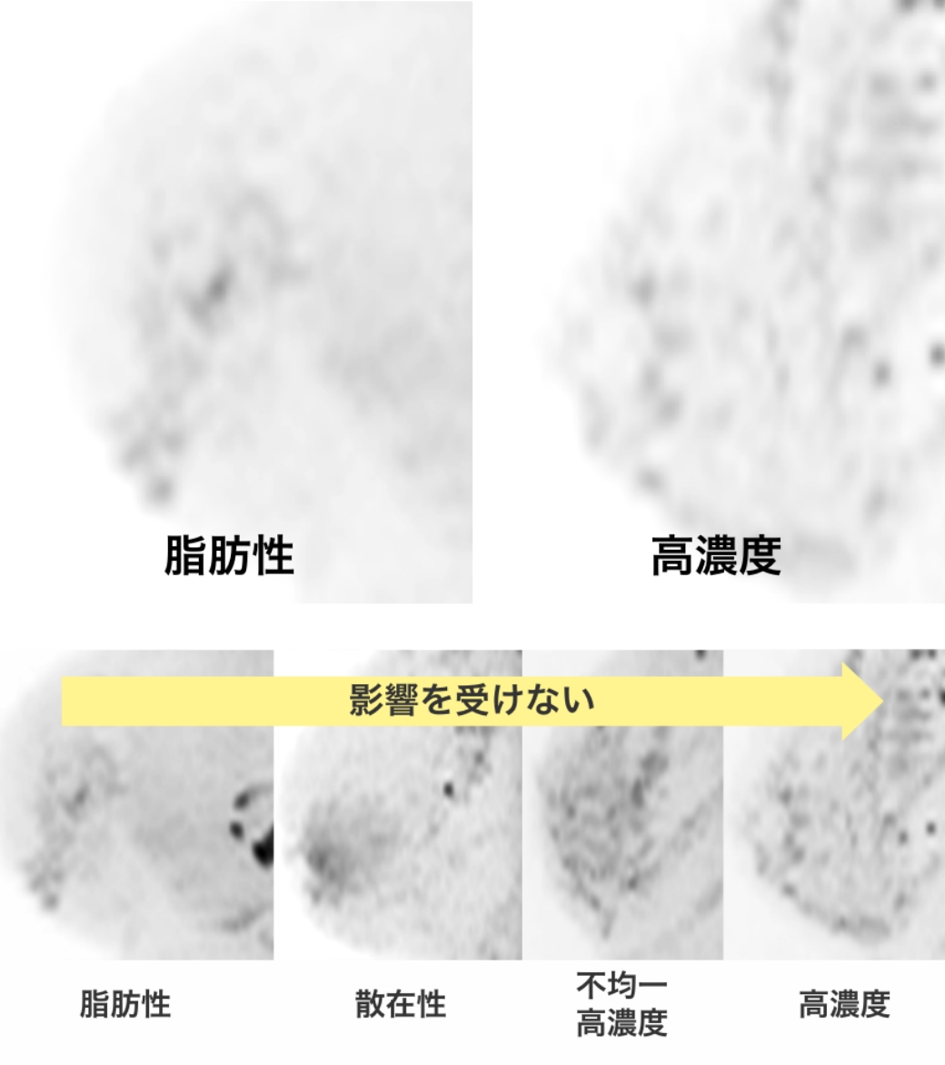 マンモグラフィ検査でのがんの見え方のイメージ