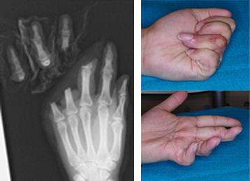 左写真：左中・環・小指完全切断右写真：術後2年