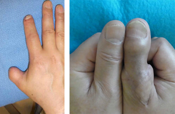 左写真：母指の切断後の欠損右写真：左は健側の母指、右が足趾で再建した指