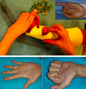 上写真：専門のハンドセラピスト（作業療法士）の指導のもと、リハビリを行っているところです。（右上：左環指屈筋腱損傷）下写真：術後１年、正常まで回復