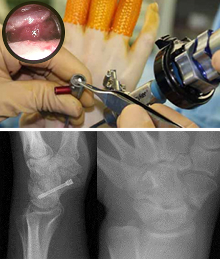 上写真：術中写真¥下写真左舟状骨偽関節　左：術前　右：術後