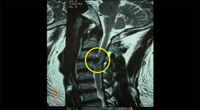 頚椎椎間板ヘルニアのMRI画像