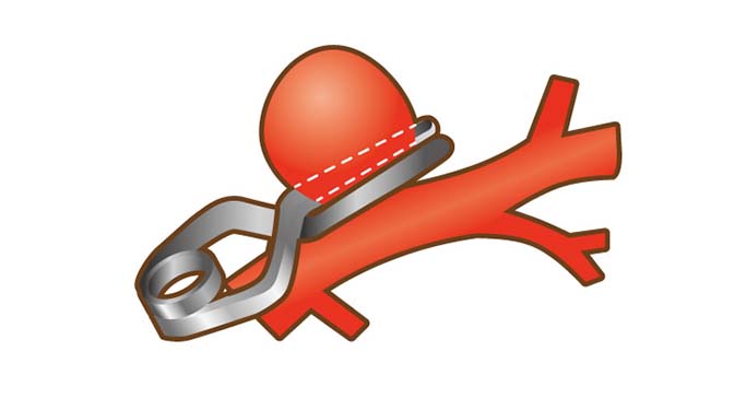 脳動脈瘤クリッピング術