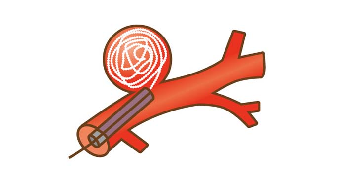 脳動脈瘤コイル塞栓術