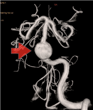 大型脳底動脈瘤3次元脳血管撮影像