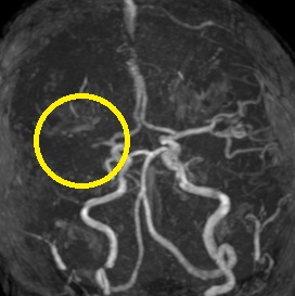 右大脳動脈閉塞(来院時MRA検査画像)