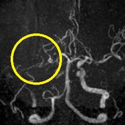 超急性期血管内治療01