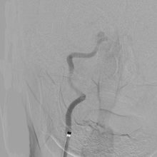 超急性期血管内治療02