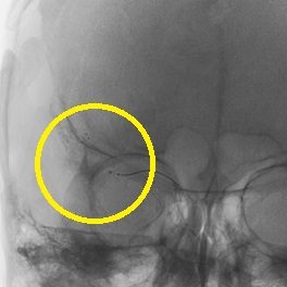 超急性期血管内治療04