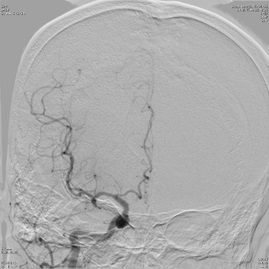 超急性期血管内治療05