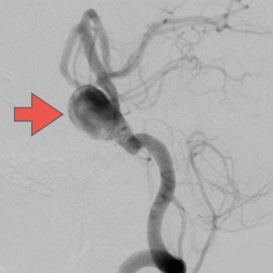 大型脳底動脈瘤