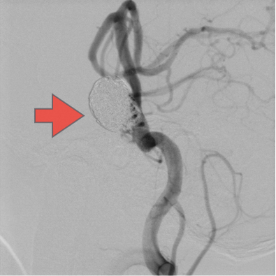 大型脳底動脈瘤