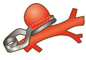 脳動脈瘤クリッピング術01