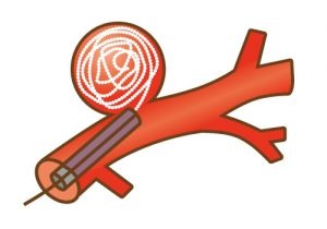 脳動脈瘤クリッピング術02