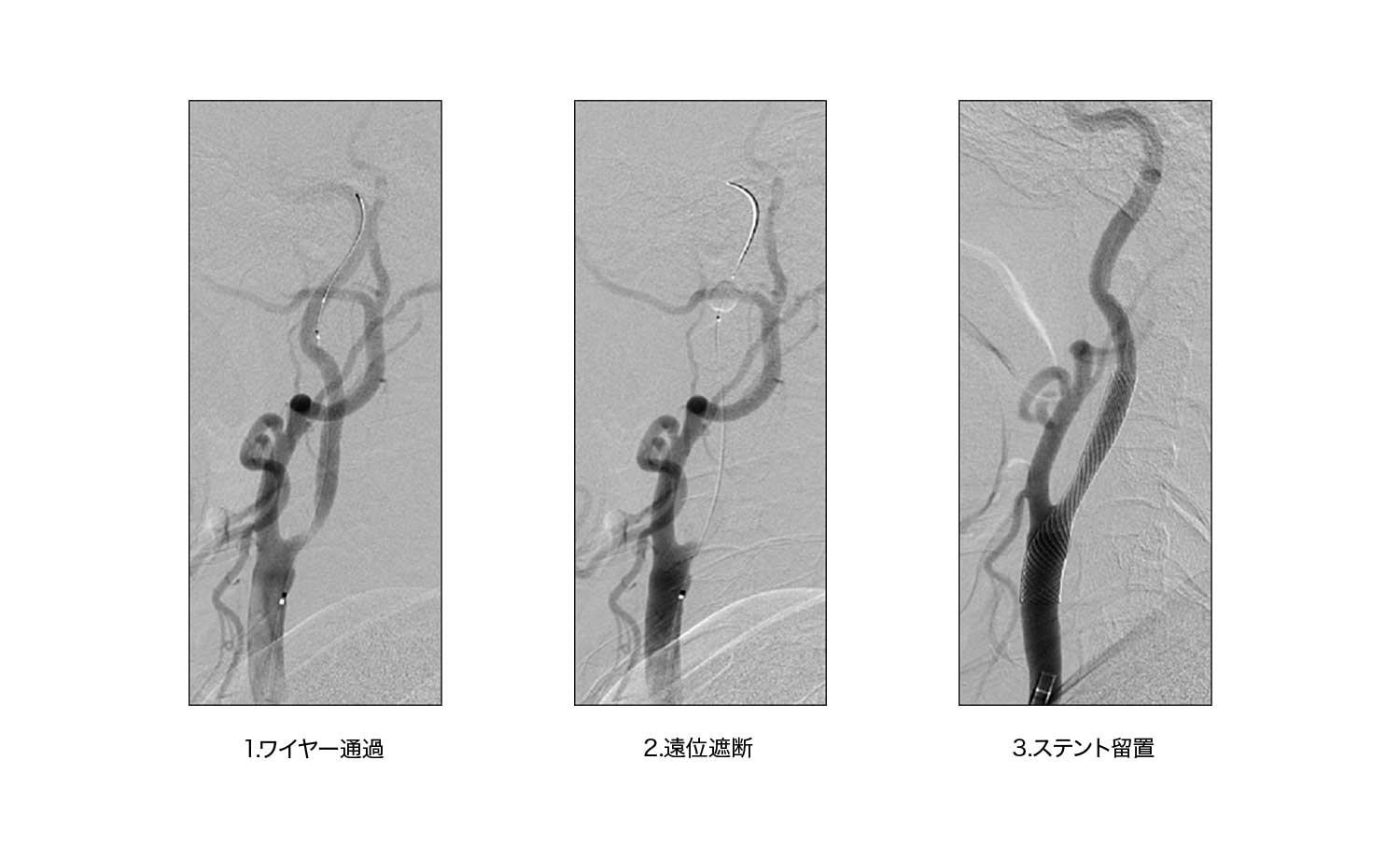 頸動脈ステント留置術