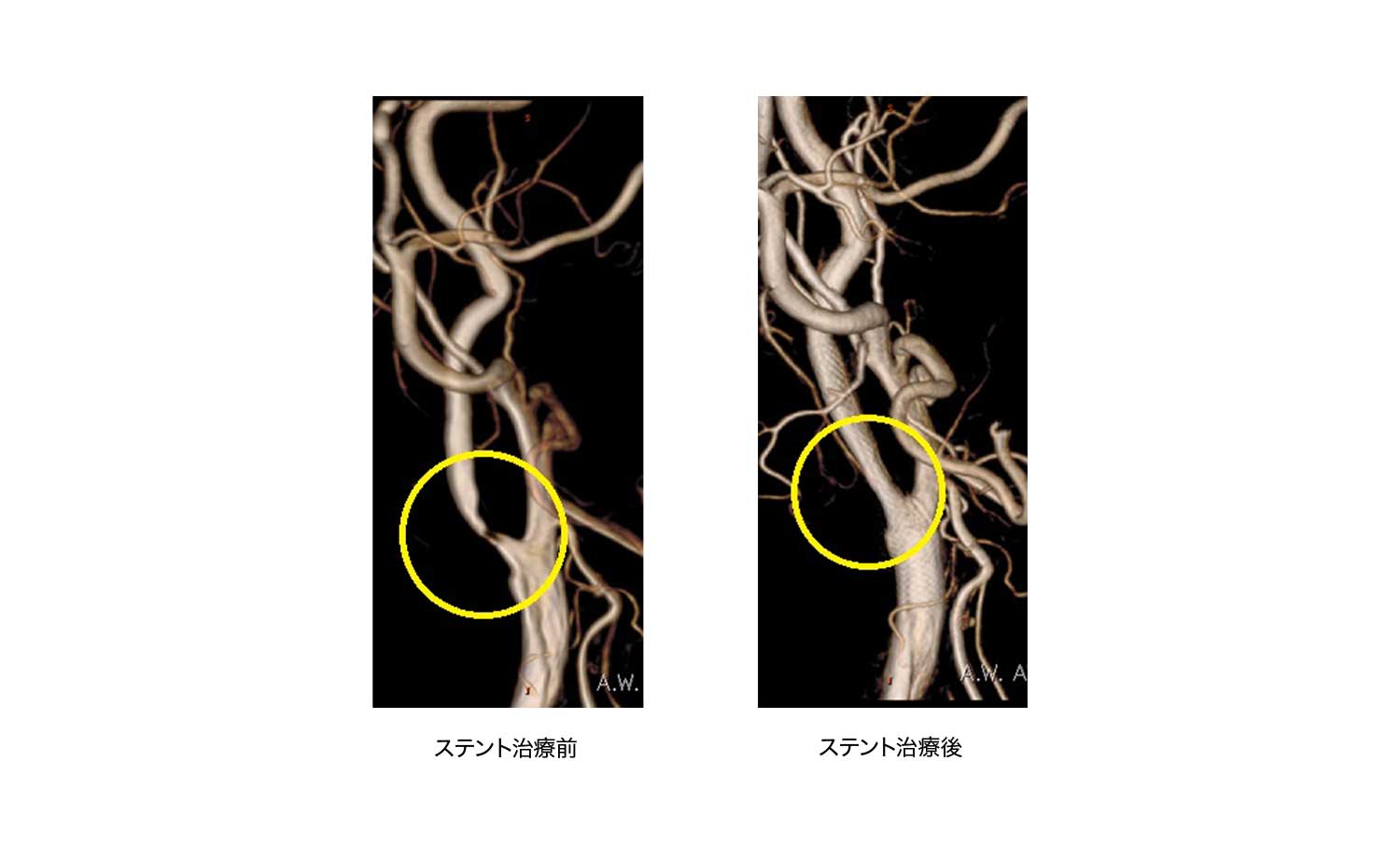 ステント治療ビフォーアフター