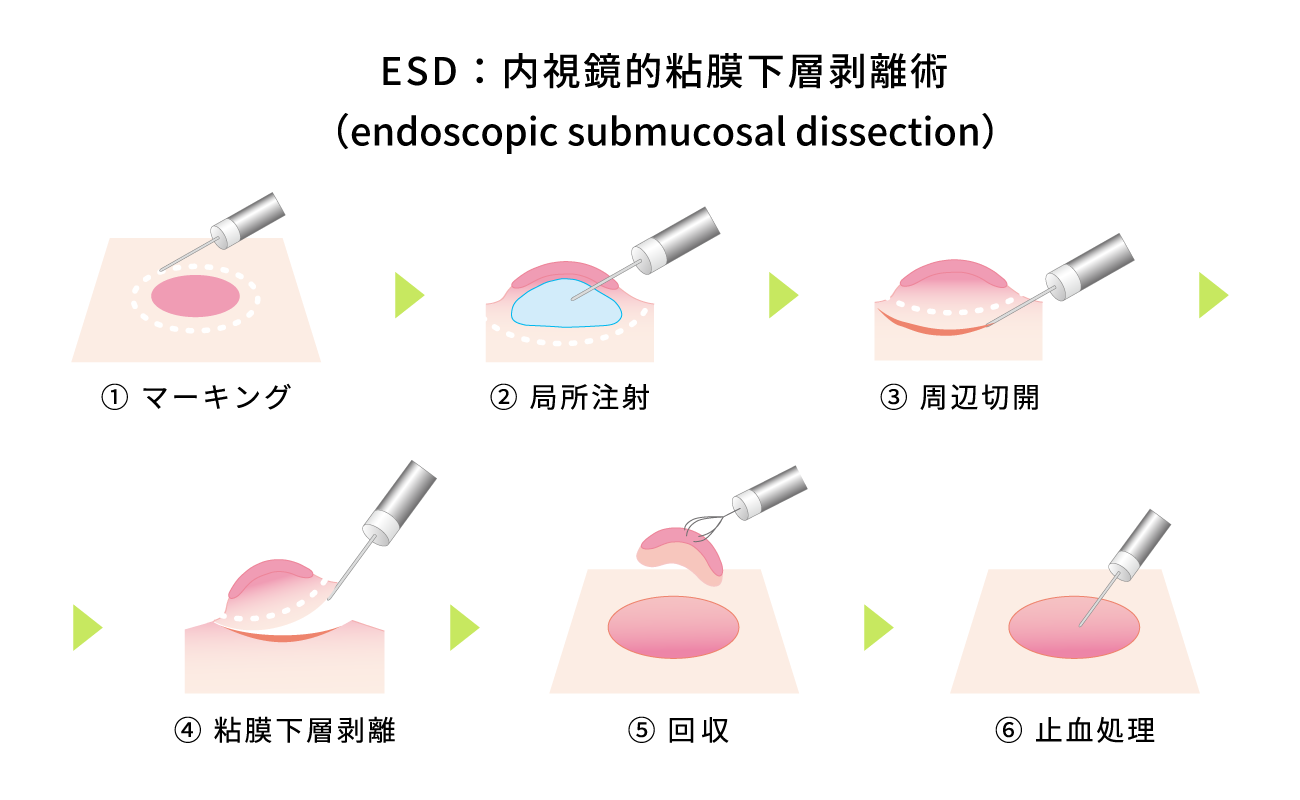 ESD（内視鏡的粘膜下層剥離術）の図解